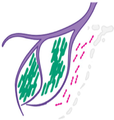 Ultrastructural remodelling of tau fibrils during ghost tangle formation in Alzheimer’s disease brain Ultrastructural remodelling of tau fibrils during ghost tangle formation in Alzheimer’s disease brain